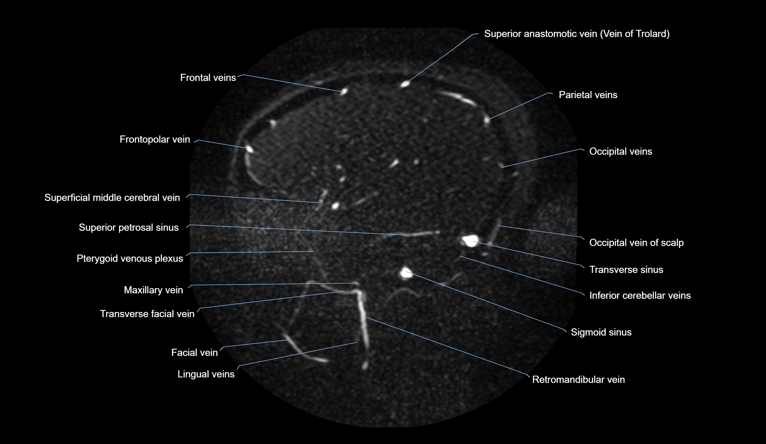 MRV brain sagittal anatomy 3T MRI images -img-01015-00062.webp